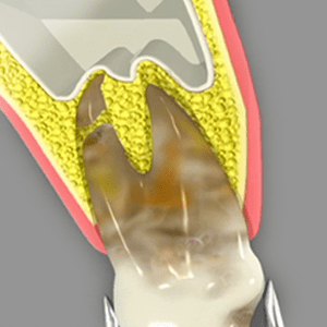 Tooth Extraction as an example of oral surgery in Cary NC
