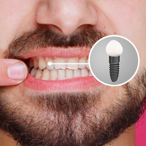 Man showing his teeth illustrating dental implants