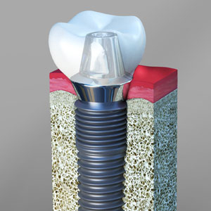 Making the Right Choice: Dental Implants in Cary