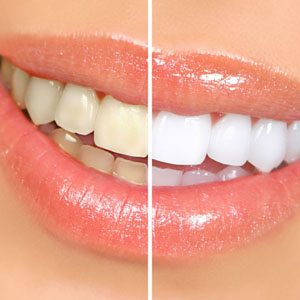 Natural teeth whitening solutions