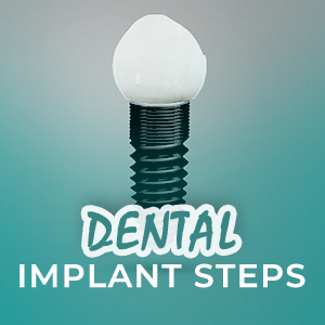 4 Steps Of Dental Implant Procedure