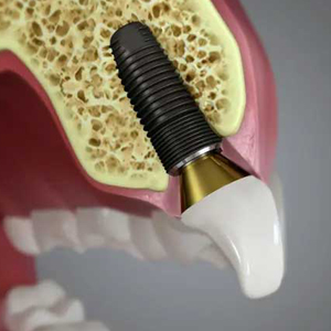 Dental Implants: Here's Why You Need Them