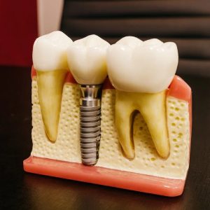 If I Have Dental Implants, Can I Use Invisalign?