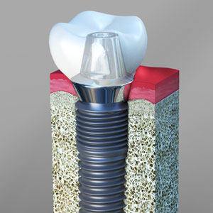 Dental Implants Procedure, Cost, Types, Problems & Safety