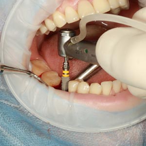How Dental Implants Preserve Bone Health?