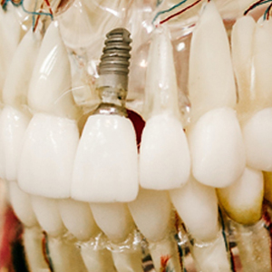 Throwing Light on Dental Implants Treatment