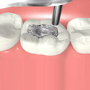 Three teeth are shown, each with a different material for dental fillings