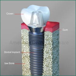 Diagram of a dental implant used by a Dentist that does dental implants in Cary and Raleigh NC