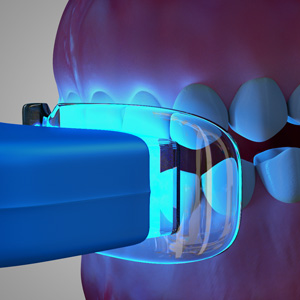 A diagram of a teeth whitening dentist in North Carolina