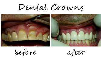 Dental Crowns 1