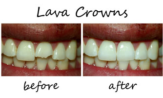 Lava Crowns