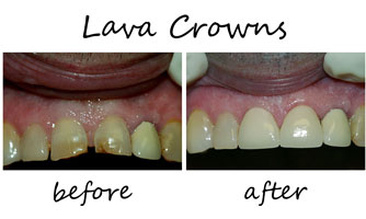 Lava Crowns