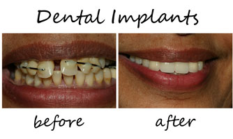 Dental Implants