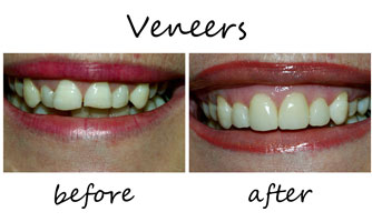 Veneers 2