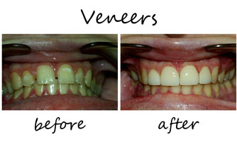 Veneers 3