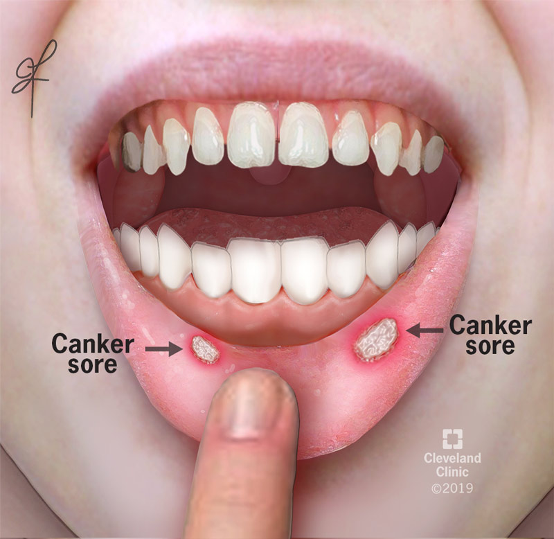 Canker Sore