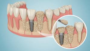 Bone Grafts as an example of oral surgery in Cary NC