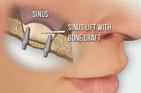 Sinus Grafts as an example of oral surgery in Cary NC