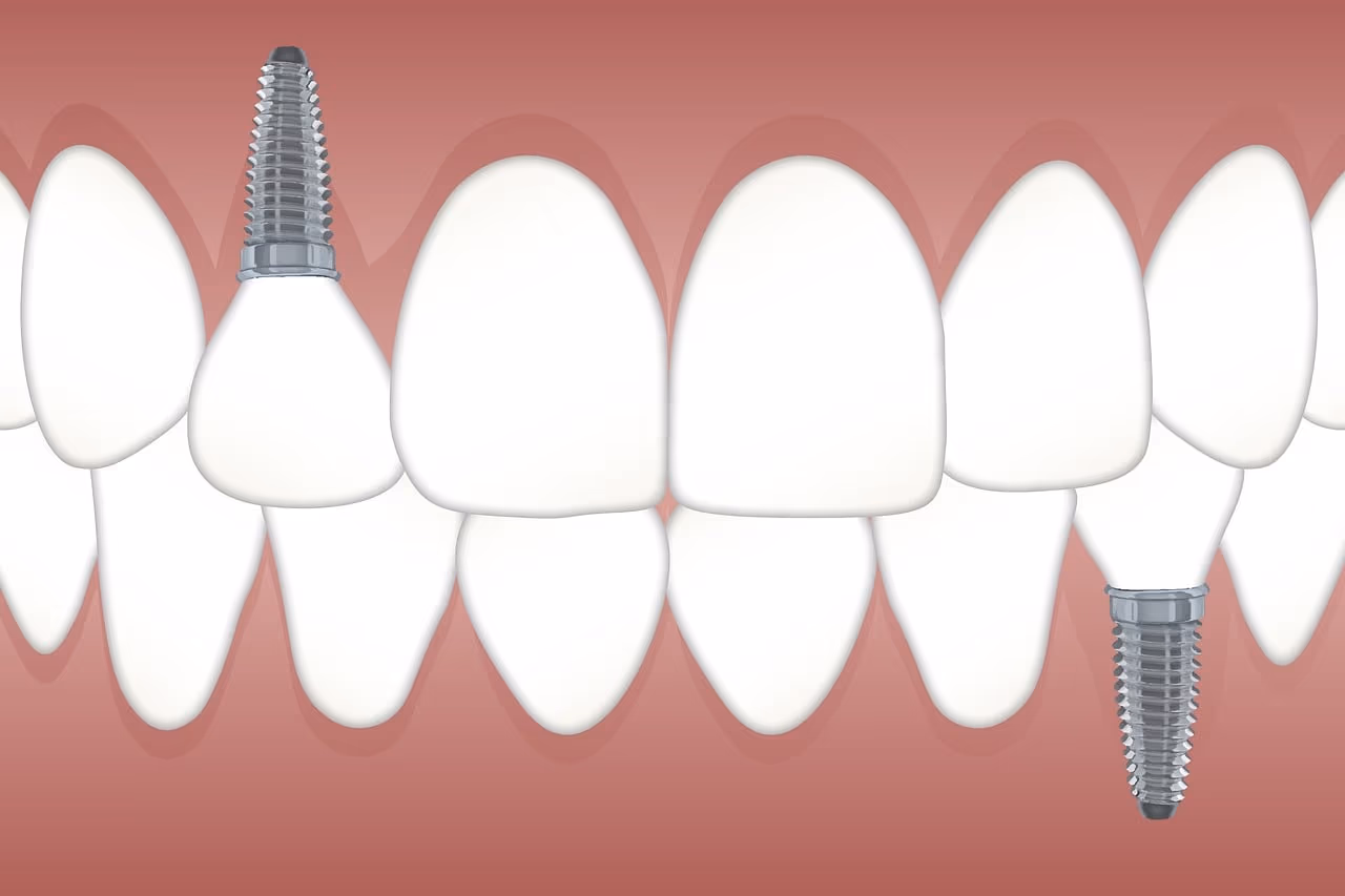 Illustration of two titanium dental implants set in the jawbone alongside natural teeth