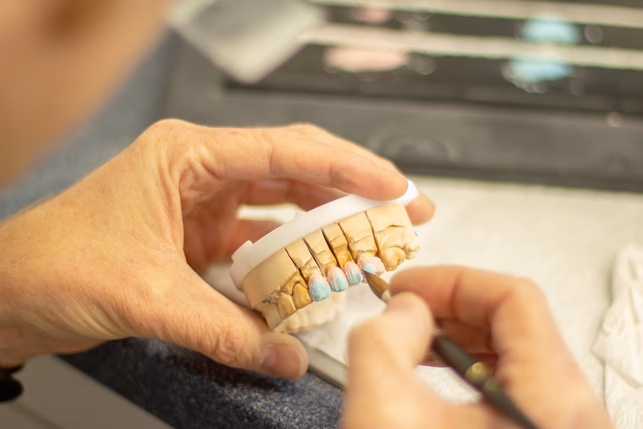 A dental technician shaping a crown on a plaster model of the upper and lower teeth