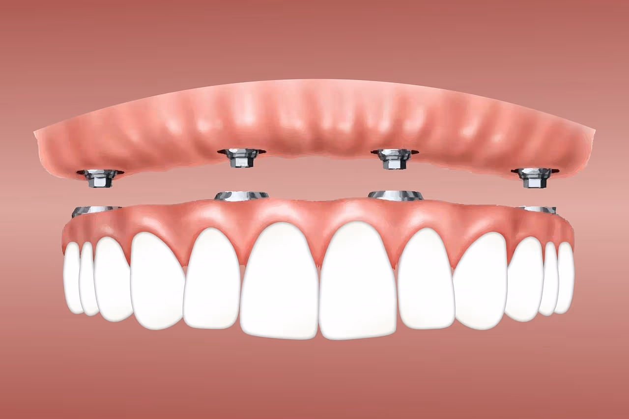 Illustration of an implant-supported overdenture lifted above four implants fixed in the lower jaw