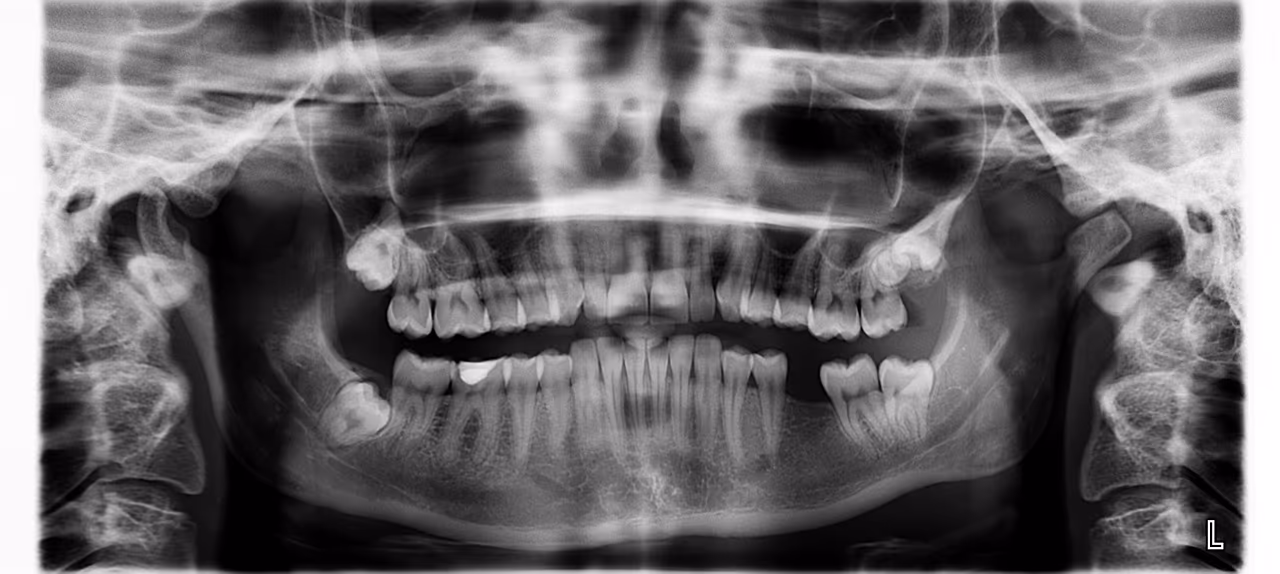 Panoramic dental X-ray of the upper and lower jaws showing a gap where a tooth is missing