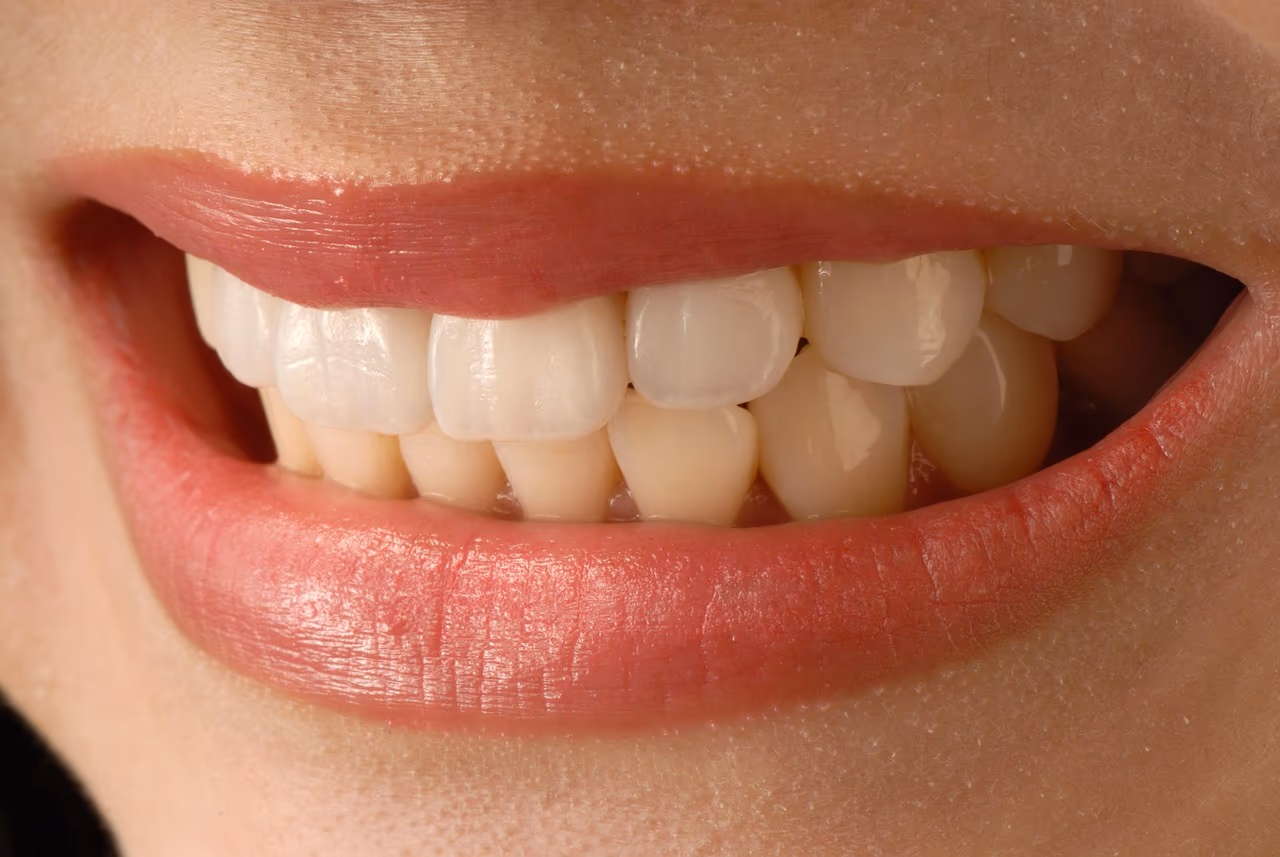 Close-up of a smile with even, natural-looking porcelain veneers on the upper front teeth