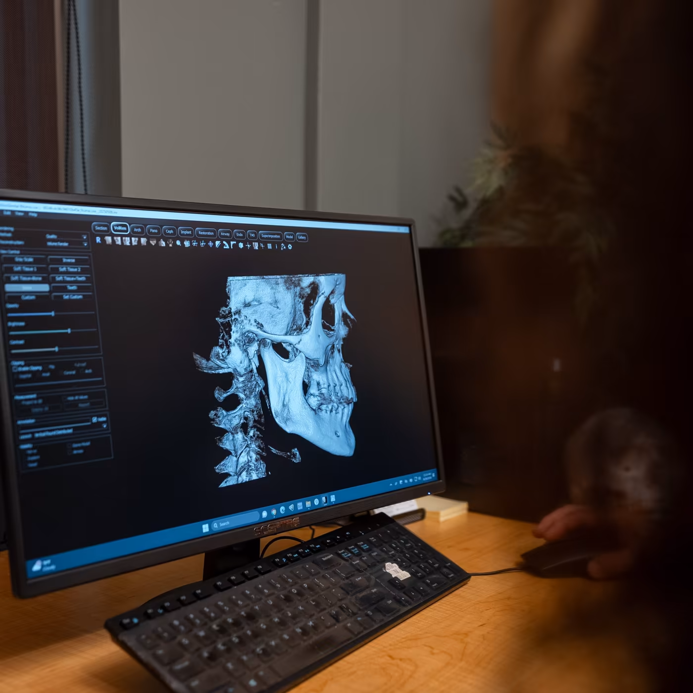 A 3D scan of a patient's skull and jaw on a monitor at Smiles of Cary